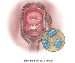 Điều trị viêm cổ tử cung khi mang thai tuần 18 bằng đơn thuốc phối hợp